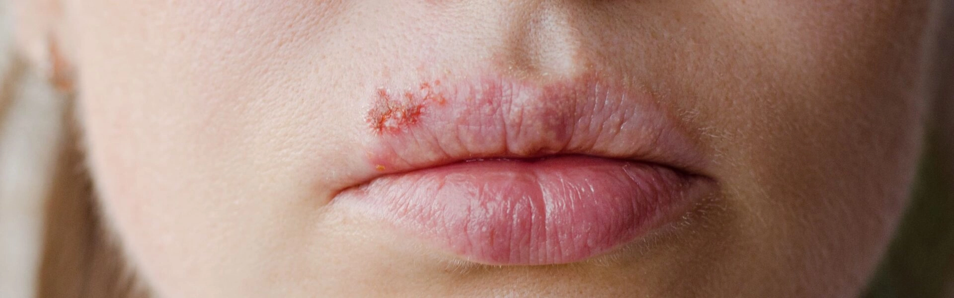 Warum entsteht Lippenherpes und was kann man dagegen tun?